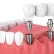 Dental Treatment and Implantation in Turkey